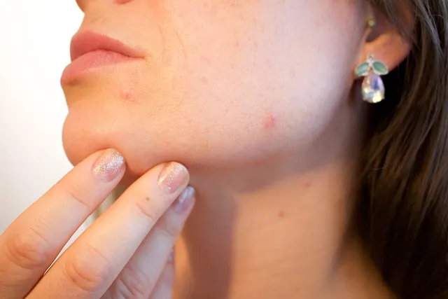 Acne and Gut Health: The Skin-Gut Axis