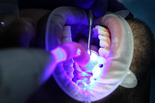 Teeth Whitening: Safe Methods