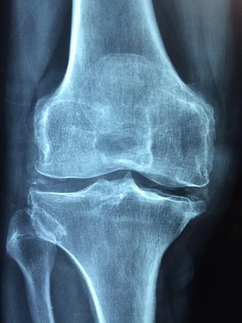 knee, old, care, injury, pain, knee pain, inflammation, osteoarthritis,